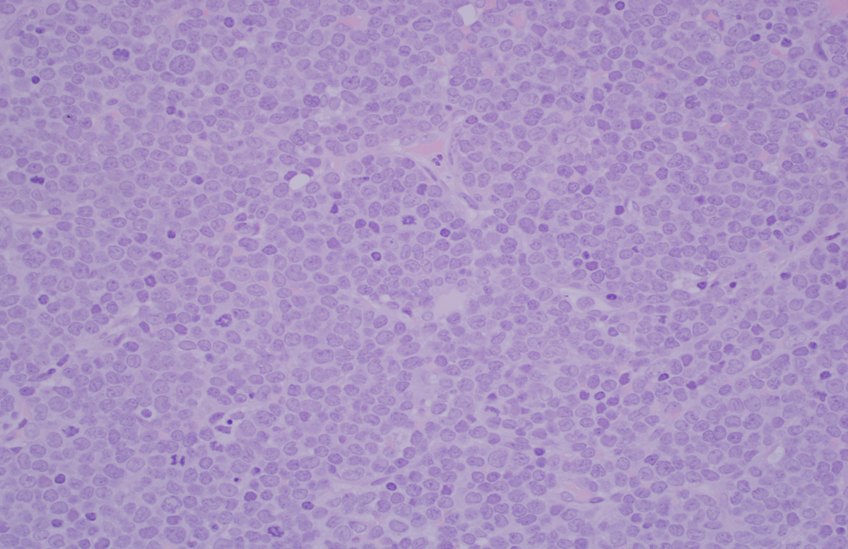 Figure 3 Lymph node